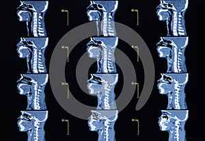 Series of images from a computerized tomography of neck