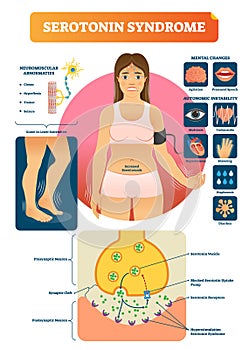 Serotonin syndrome vector illustration with medical labeled symptoms scheme