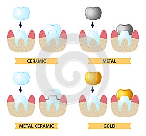 Service installation of a ceramic crown. Icons on the dental Theme.