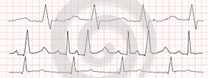 Set of black heartbeat diagrams on red graph paper. ECG electrocardiogram chart. Cardiac rhythm line. Cardio test signs