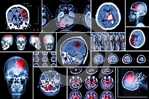 Set , Collection of brain disease ( Cerebral infarction , Hemorrhagic stroke , Brain tumor , Disc herniation with spinal cord comp