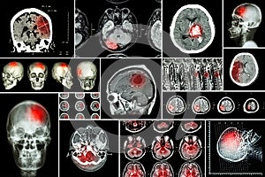 Set , Collection of brain disease ( Cerebral infarction , Hemorrhagic stroke , Brain tumor , Disc herniation with spinal cord comp photo