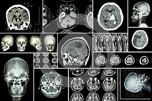 Set , Collection of brain disease ( Cerebral infarction , Hemorrhagic stroke , Brain tumor , Disc herniation with spinal cord comp