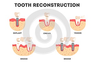 Set of diffrent human teeth reconstruction kind. Tooth loss and repacement.