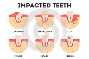 Set of diffrent impacts on human teeth. Dental and oral diseases.