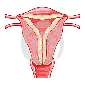 Set of Endometrial hyperplasia Female reproductive system uterus with thick endometrium layer. Front view in a cut