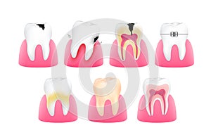 Set of healthy and unhealthy tooth.