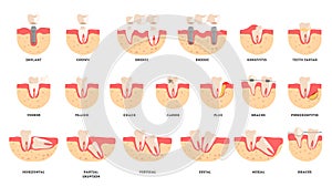 Set of human teeth in diffrent condition. Dental health and disease concept.