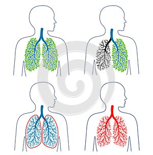 Set of illustrations of respiratory system theme.Tuberculosis. Lung disease. Lungs cancer. Promotion of healthy
