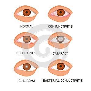 Set of the most common eye diseases isolated photo