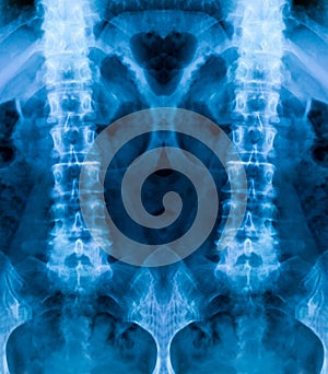 Set of X-ray of the bones of the human lower lumbar part of the vertebral column