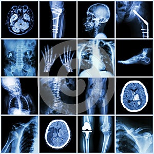 Set of X-ray multiple part of human,Multiple disease,orthopedic,surgery