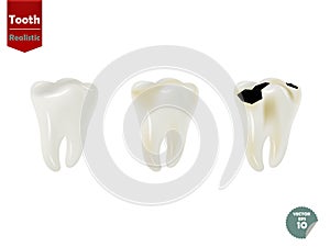 Set of realistic tooth including healthy tooth and decayed tooth
