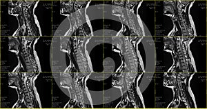 Set of sagittal MRI scans of neck area of caucasian 34 years old male with bilateral paramedial extrusion of the C6-C7