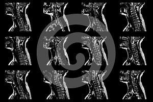 Set of sagittal MRI scans of neck area of caucasian male with bilateral paramedial extrusion of the C6-C7 segment with