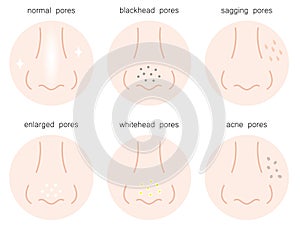 Set of skin pores on human nose, normal pores, sagging pores, open pores, blackhead pores, whitehead pores, acne scar pores.