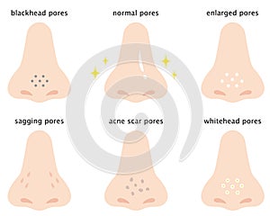 Set of skin pores on human nose, normal, sagging, open , blackhead, whitehead, acne scar. Beauty skin care concept