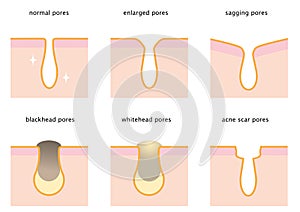 Set of skin pores: normal, sagging, enlarged, blackhead, whitehead and acne scar