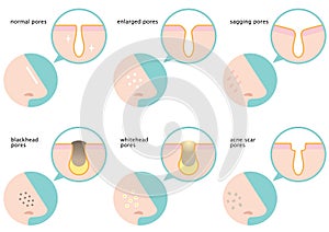 Set of skin pores on nose: normal, sagging, enlarged, blackhead, whitehead and acne scar