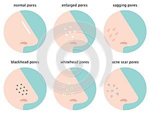 Set of skin pores on nose: normal, sagging, enlarged, blackhead, whitehead and acne scar photo
