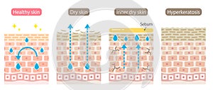 Set of skin type. Dry, inner dry, oily, healthy, and hyperkeratosis skin cell layer. Healthy and Beauty skin care concept