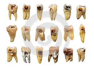 Set of teeth with dental caries tooth decay , fluorosis and calculus . isolated background