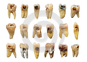Set of teeth with dental caries tooth decay , fluorosis and calculus . isolated background photo