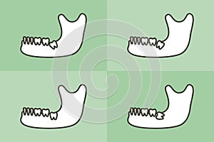 Set of type of wisdom tooth in mandible or lower jaw