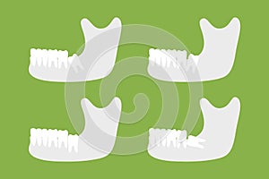 Set of type of wisdom tooth with mandible or lower jaw