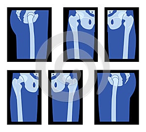 Set of X-Ray Hip and Leg, Head of the femur, Skeleton Human body Bones adult people roentgen front back side view. 3D