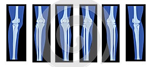 Set of X-Ray Knee femur leg Skeleton Human body - Patella, epicondyle, Tibia, Fibula Bones adult people roentgen front photo
