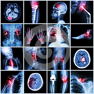 Set of X-ray multiple part of human,Multiple disease,orthopedic,surgery (Stroke,Bone fracture,Orthopedic operationKidney