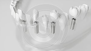 Several implants in a glassy jaw - 3d rendering
