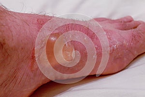 Severe burn and blister on legs, close-up