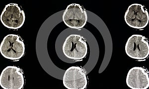 severe depression fracture of a skull