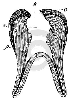 Severe form of tooth decay. Teeth becoming hollow.