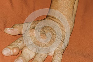 Severe gout in men suffering from joint pain, bone pain, gout, rheumatoid symptoms, radioactive sickness,