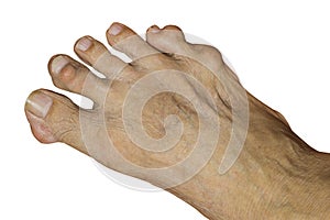 Severe gout in men suffering from joint pain, bone pain, gout, rheumatoid symptoms, radioactive sickness,