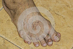 Severe gout in men suffering from joint pain, bone pain, gout, rheumatoid symptoms, radioactive sickness