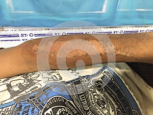 Severe niacin deficiency or pellagra or photosensitive dermatitis in right forearm of alcoholic adult patient