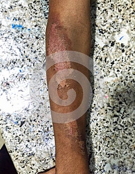 Severe niacin deficiency or pellagra or photosensitive dermatitis in right forearm of alcoholic adult patient