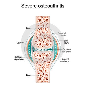 Severe osteoarthritis. Synovial joint