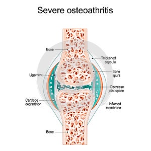 Severe osteoarthritis. Synovial joint photo
