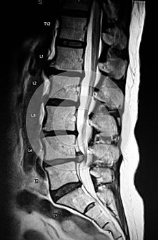 Severe pathology of lumbar spine herniation mri