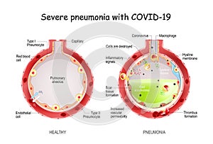 Severe pneumonia with COVID-19