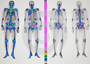 cancer metastasis photo