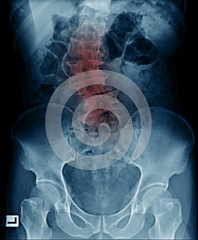 scoliosis lumbar x-ray image photo