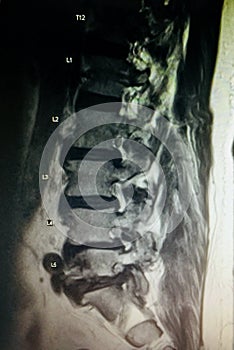 Severe spinal canal stenosis pathology mri exam