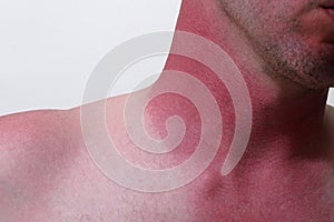 Severe Sunburn on the Neck of a Causasian Male