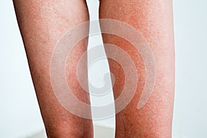 Severe sunburn, summer tan, poor sun protection. Sun allergies, obstruction, itching pain and blisters on the skin of the legs